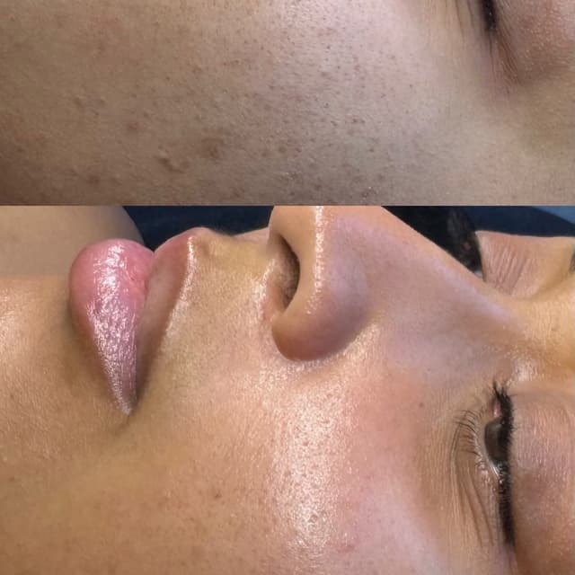 Acne bootcamp at The Esty MUA in Pawtucket, RI