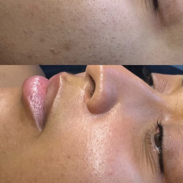 Acne boot camp express at The Esty MUA in Pawtucket, RI